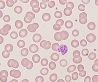 Mature schizont of Plasmodium vivax in peripheral blood 2