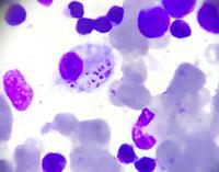 BONE MARROW ASPIRATE ( GEIMSA) 1000X
