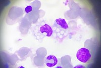 Bone Marrow aspirate ( Geimsa) 1000 x