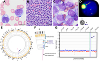 Optical genome mapping reveals a MYC-amplified ring chromosome arising through chromoanagenesis in AML