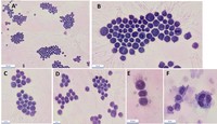 Hairy (villous) plasma cells in the cerebrospinal fluid (CSF)