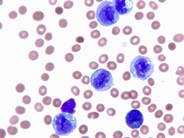 Acute monocytic leukemia - peripheral blood