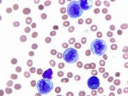 leukemia blood