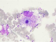 Hemophagocytosis and Leishmaniasis