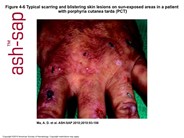 Skin lesions in porpyria cutanea tarda